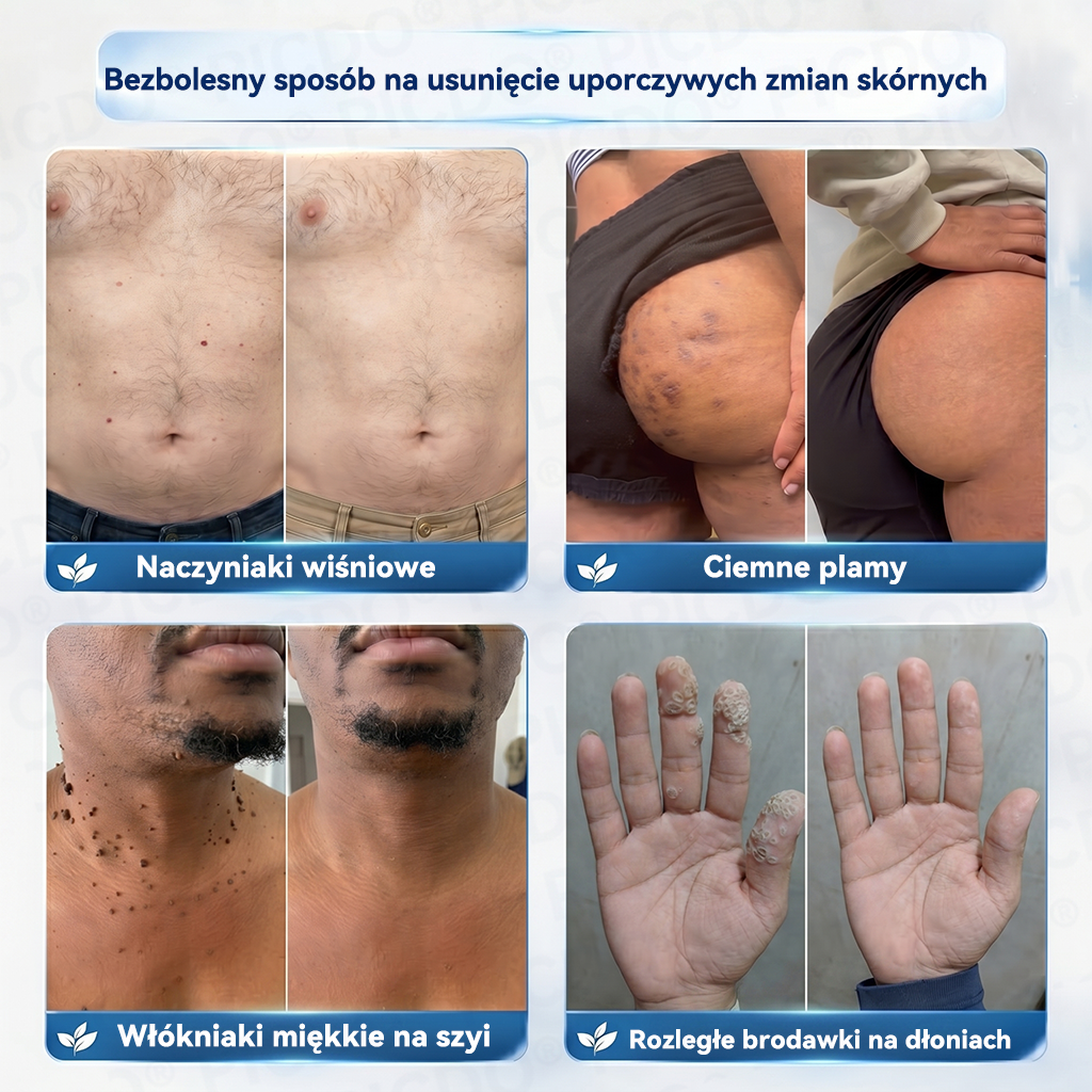 🏥🥼 𝐏𝐢𝐜𝐝𝐨® 7-𝐃𝐧𝐢𝐨𝐰𝐲 𝐊𝐫𝐞𝐦 𝐝𝐨 𝐔𝐬𝐮𝐰𝐚𝐧𝐢𝐚 𝐁𝐫𝐨𝐝𝐚𝐰𝐞𝐤 𝐢 𝐍𝐢𝐞𝐝𝐨𝐬𝐤𝐨𝐧𝐚𝐥𝐨ś𝐜𝐢 𝐒𝐤ó𝐫𝐲🩵 (𝑭𝒐𝒓𝒎𝒖ł𝒂 𝑩𝒆𝒛 𝑩ó𝒍𝒖 𝒊 𝑩𝒆𝒛 𝑩𝒍𝒊𝒛𝒏) 💎